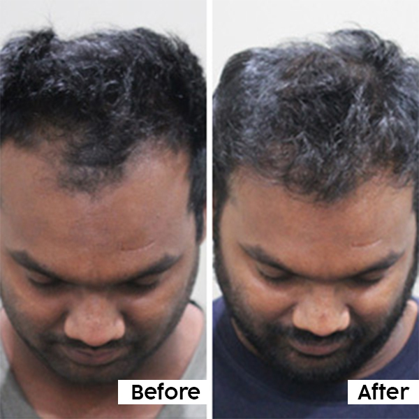 How to Use Hair Serum in Hindi | हेयर सीरम लगाने का तरीका