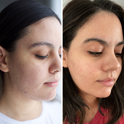 Pineapple Depigmentation Regime with Serum & Glutathione Effervescent