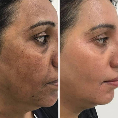 Pineapple Depigmentation Regime with Serum & Glutathione Effervescent