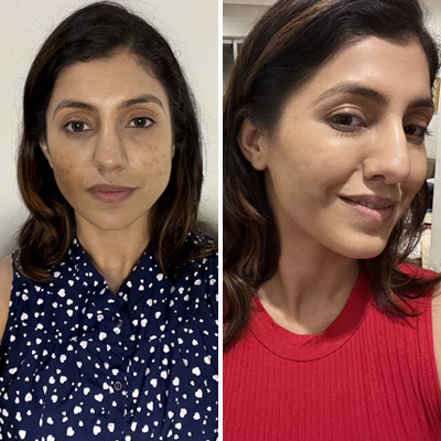 Pineapple Depigmentation Regime with Serum & Glutathione Effervescent